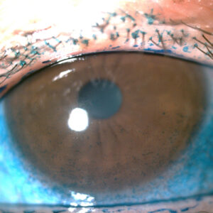 Read more about the article Xiidra out of the comfort zone