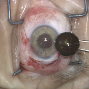 Read more about the article MSICS and its place in the hands of young eye surgeons