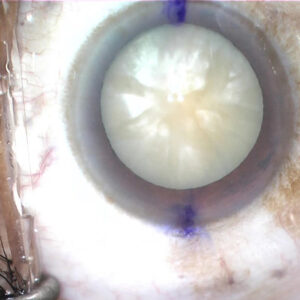 Read more about the article Better management of brunescent and dense white cataracts
