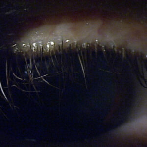 Read more about the article Dry eye during the COVID-19 pandemic