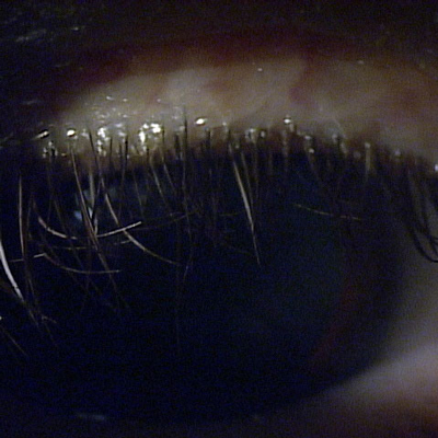 This photograph demonstrates the utility of cell phone cameras in augmenting the telehealth dry eye experience. As demonstrated, the quality of the image is enough to see that the patient has diffuse collarettes (cylindrical dandruff at base of upper lid margin), indicative of severe Demodex blepharitis. There is significant misdirection of lashes as a result as well. Source: Elizabeth Yeu, MD