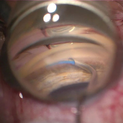 Read more about the article Hurdles facing MIGS