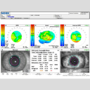 Read more about the article The many considerations of astigmatism management