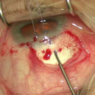 Read more about the article Where do eye drops fit in the era of interventional glaucoma?