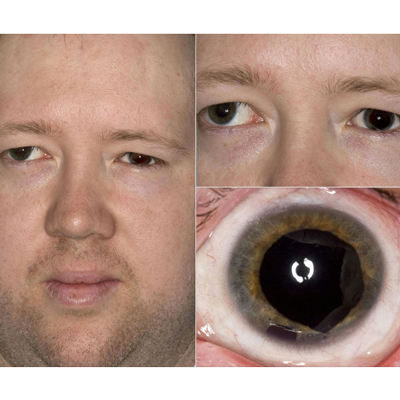 Read more about the article Current options in artificial irises