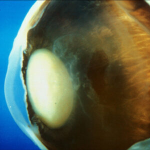 Read more about the article The search for a pharmacologic cataract solution