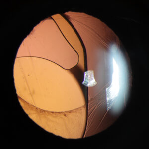 Read more about the article Pearls for refixating and exchanging IOLs