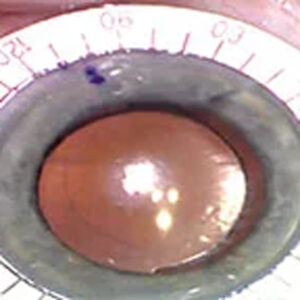 Read more about the article Residual astigmatism: What to do about it