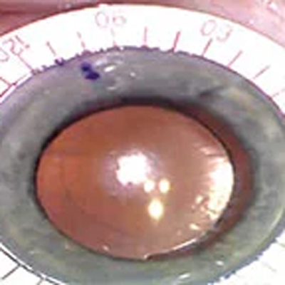 Read more about the article Residual astigmatism: What to do about it