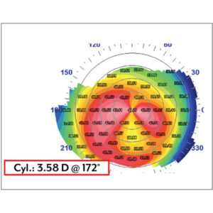 Read more about the article Prepping the ocular surface for cataract surgery