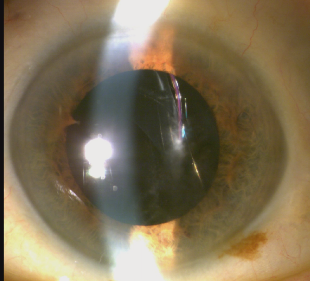 The lens-bag complex is dislocated in this eye with a “dead bag.” Despite being more than 10 years postop, there is no fibrosis of the capsular bag. The capsule is very thin and diaphanous, and the zonules are almost non-existent. It is not advised to lasso the lens-bag complex in these cases; instead the whole complex was removed and replaced with a Yamane intrascleral haptic fixation lens. Source: Steve Safran, MD