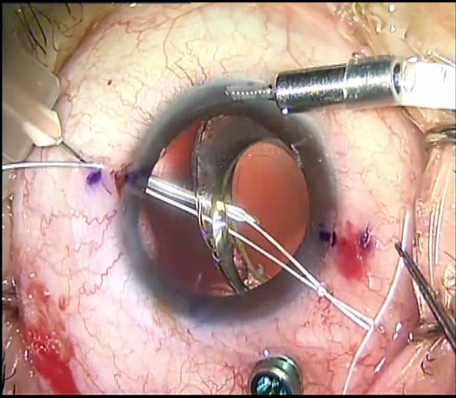 Intraoperative photograph showing a suture snare, created by threading a 27-gauge needle with a short length of Gore-Tex 7-0 suture, entering through a Hoffman pocket 1.75 mm posterior to the limbus, piercing the capsular bag and passing posterior to the IOL-capsular tension ring-capsular bag complex. The loop of the suture snare is externalized. Another length of Gore-Tex 7-0 suture is threaded through the extended loop of the suture snare. Withdrawal of the suture snare then delivers the suture to the scleral fixation point. Source: Soon Phaik Chee, MD