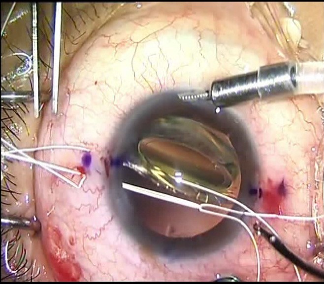 Intraoperative photograph showing the other end of the fixation suture being drawn out through the Hoffman pocket by the pre-threaded extended loop of the suture snare. This suture creates a belt loop around the IOL-capsular tension ring-capsular bag complex, drawing it into position when both Gore-Tex suture ends are withdrawn from the Hoffman pocket and tied. Source: Soon Phaik Chee, MD