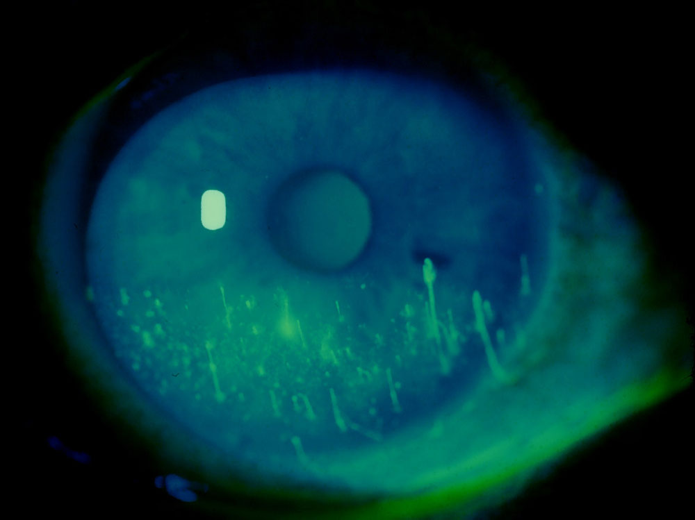 Fluorescein staining of the inferior half of the cornea with filaments in a patient with moderately severe dry eye disease Source: Gary N. Foulks, M.D.