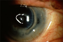 11 Example of an autoimmune corneal melt in a patient with rheumatoid arthritis.  Source: Robert K. Maloney, M.D.