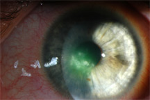 Soft contact lens-related corneal infiltrate in a 38-year-old woman. Infiltrates such as this one may require extra care in a pregnant patient.  Source: Christopher J. Rapuano, M.D.