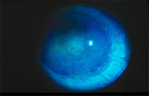 Medicamentosa. Dry-eye patients sometimes overmedicate with inappropriate drops.