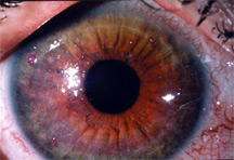 Keratoconjunctivitis sicca. Source: Peter A. D'Arienzo, M.D.
