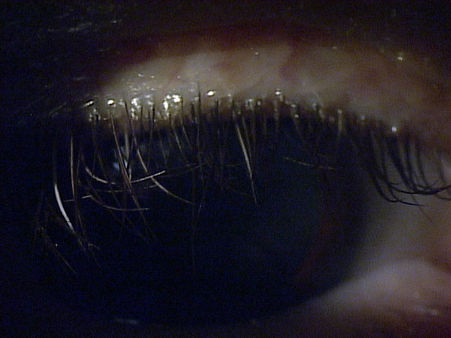 This photograph demonstrates the utility of cell phone cameras in augmenting the telehealth dry eye experience. As demonstrated, the quality of the image is enough to see that the patient has diffuse collarettes (cylindrical dandruff at base of upper lid margin), indicative of severe Demodex blepharitis. There is significant misdirection of lashes as a result as well.   Source: Elizabeth Yeu, MD