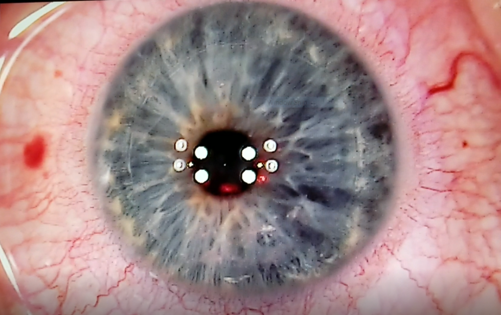 Intraoperative photo of an end of surgery LASIK flap floated back into perfect position Source: Sarah Nehls, MD