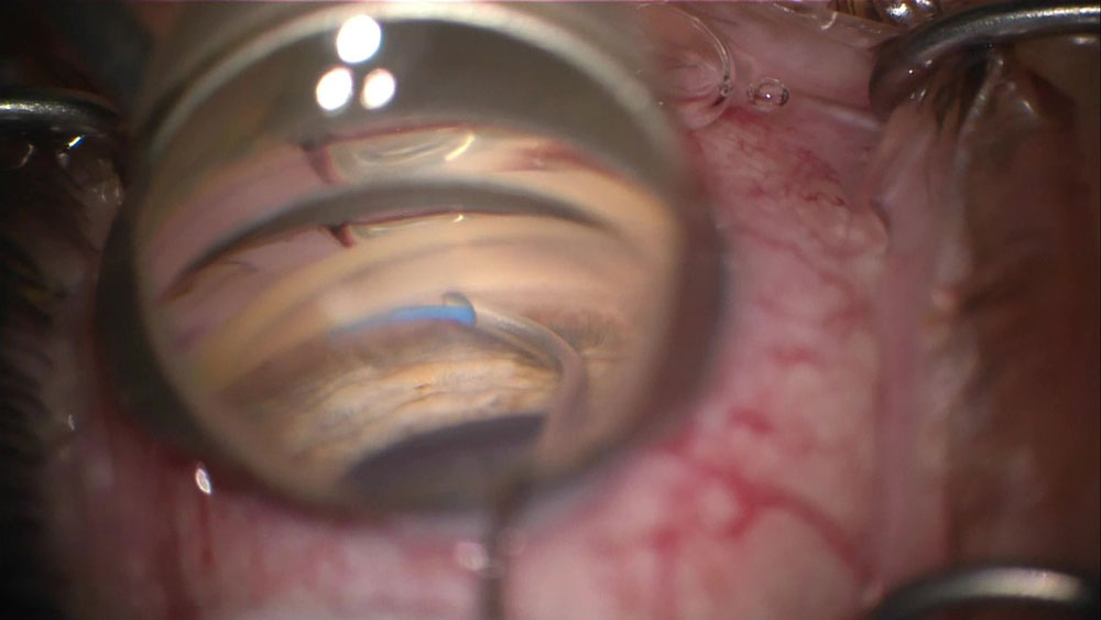 Dr. Huang operates with the Omni Surgical System (Sight Sciences).  Source: Linda Huang, MD