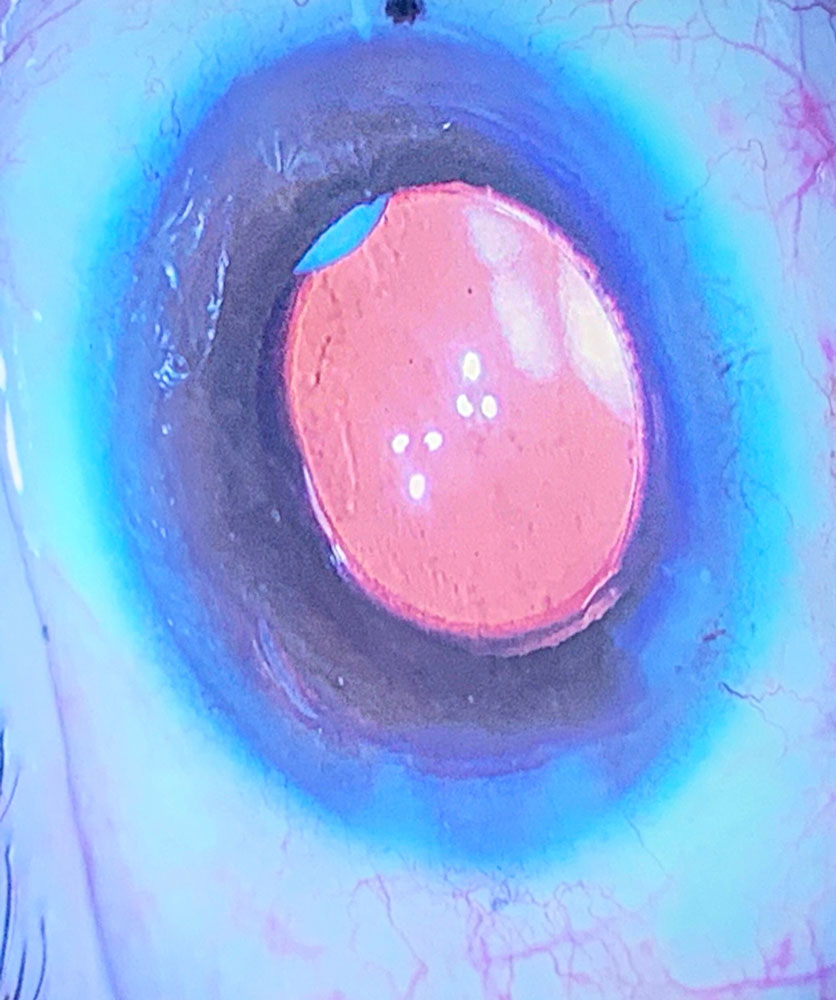 Dexycu in the posterior chamber