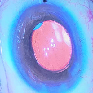Read more about the article Cataract postop regimens examined