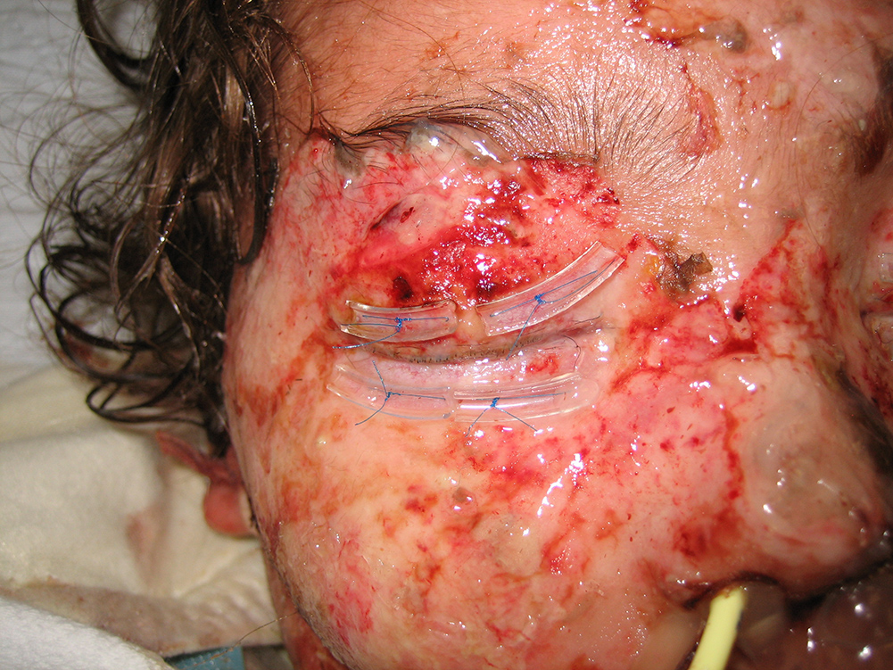 The eyelid bolsters seen in this photo is from the amniotic membrane grafts that had been applied to treat the acute phase of the syndrome Source: Darren Gregory, M.D.