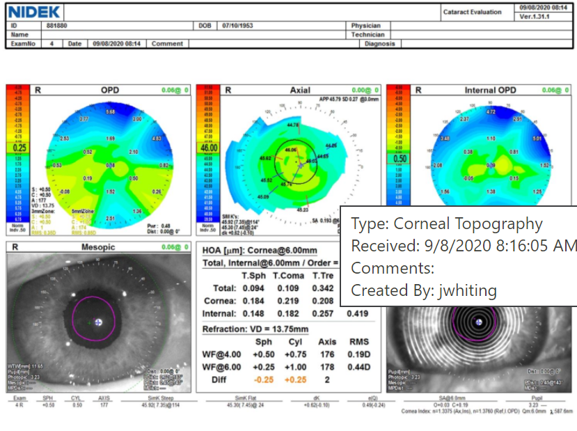 A recent patient of Dr. Ristvedt’s presented for cataract evaluation wanting a trifocal IOL. Blurred Placido images indicated dryness, which was then treated before she returned for repeat measurements. The power and orientation of the patient’s astigmatism changed after treating the dry eye. Source: Deborah Ristvedt, DO