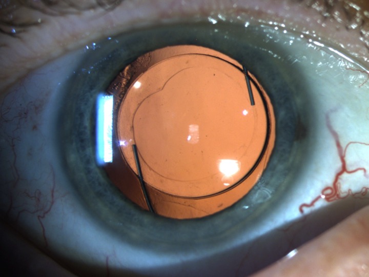 First patient implanted in the FDA PMA trial after all treatment has been done. The patient is a 70-year-old male with UCDVA 20/12 and UCNVA J2. Source: Kevin Waltz, MD