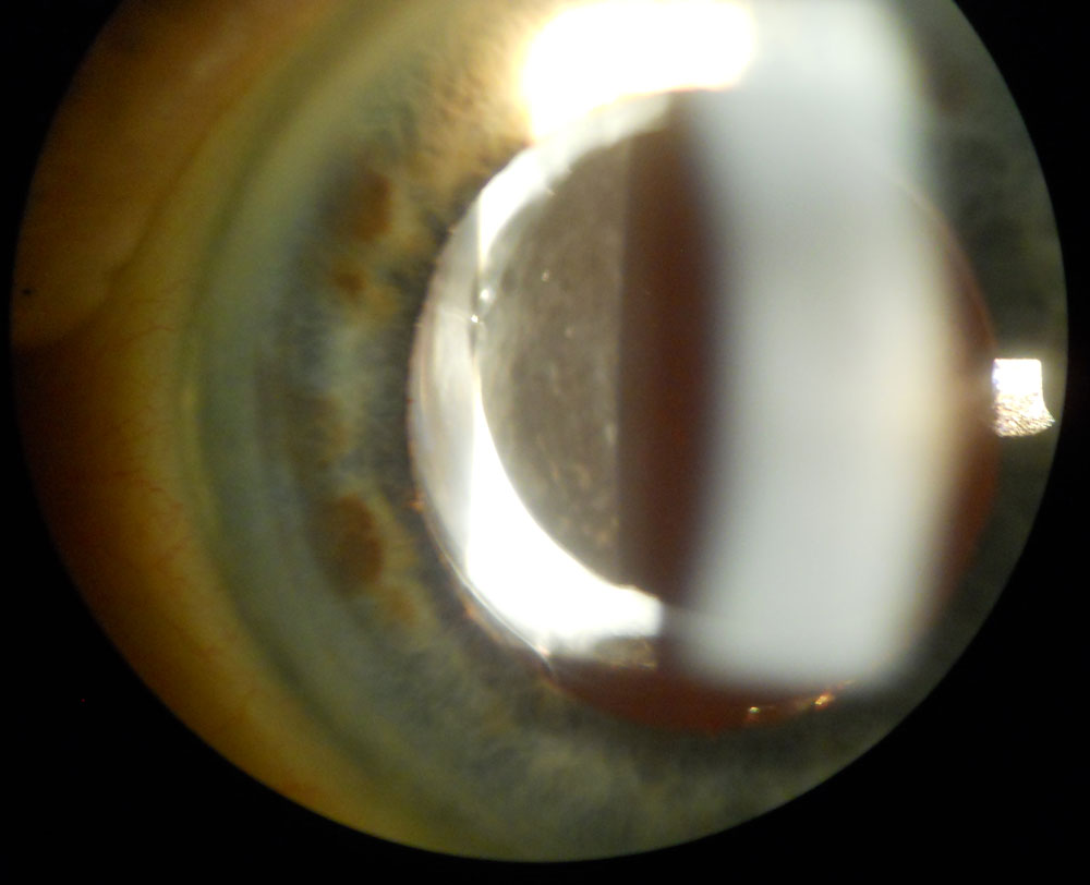 Slit lamp image shows the nasal anterior capsule overlying the anterior surface of the IOL optic prior to Nd:YAG laser anterior capsulectomy.