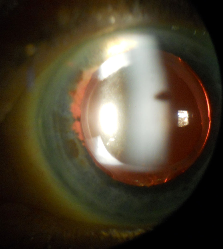 This shows the creation of an anterior capsule sector along the nasal aspect of the capsulorhexis following Nd:YAG laser anterior capsulectomy.