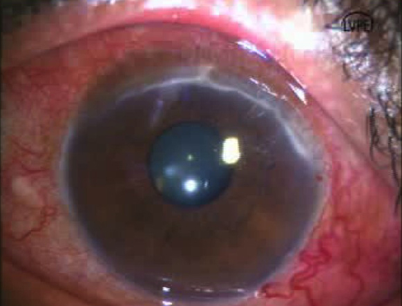 PUK with scleritis in a patient with RA Source (all): Virender S. Sangwan, M.D.