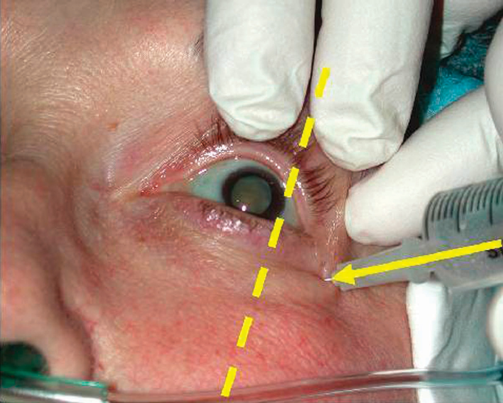 Surgeon working on a patient's eye