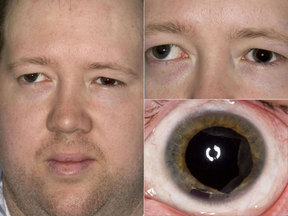 This man suffered a hockey puck injury to his left eye in 2014 when he was 28 years old, resulting in globe rupture and orbital floor fracture. After the globe repair and several surgeries to repair a retinal detachment, he was aphakic and had both a traumatic mydriasis and large inferior iridectomy. Source: Kevin M. Miller, MD