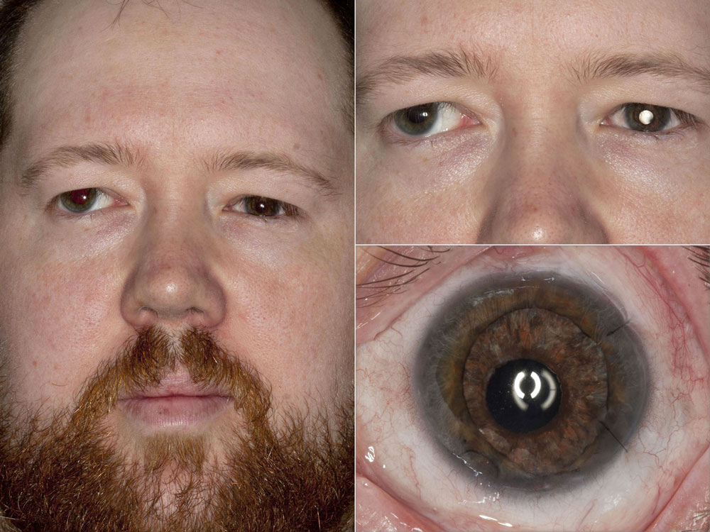 Three months after implantation and scleral suture fixation of a HumanOptics artificial iris and intraocular lens, his cornea remained clear and the artificial iris was both functional and cosmetically acceptable. The two 10-0 nylon sutures were removed subsequently. Source: Kevin M. Miller, MD