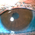 Relatively severe dry eye patient with aqueous deficiency had almost complete resolution in 1 month of treatment with Xiidra Source: Henry Perry, MD