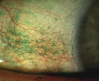 Lissamine green (LG) staining of the conjunctiva in a patient with mild dry eye. LG is a valuable vital dye to use because it is very sensitive and highlights even early devitalization of conjunctival epithelium.