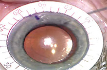 Marking the current and ideal axis for targeted rotation Source: John Berdahl, MD