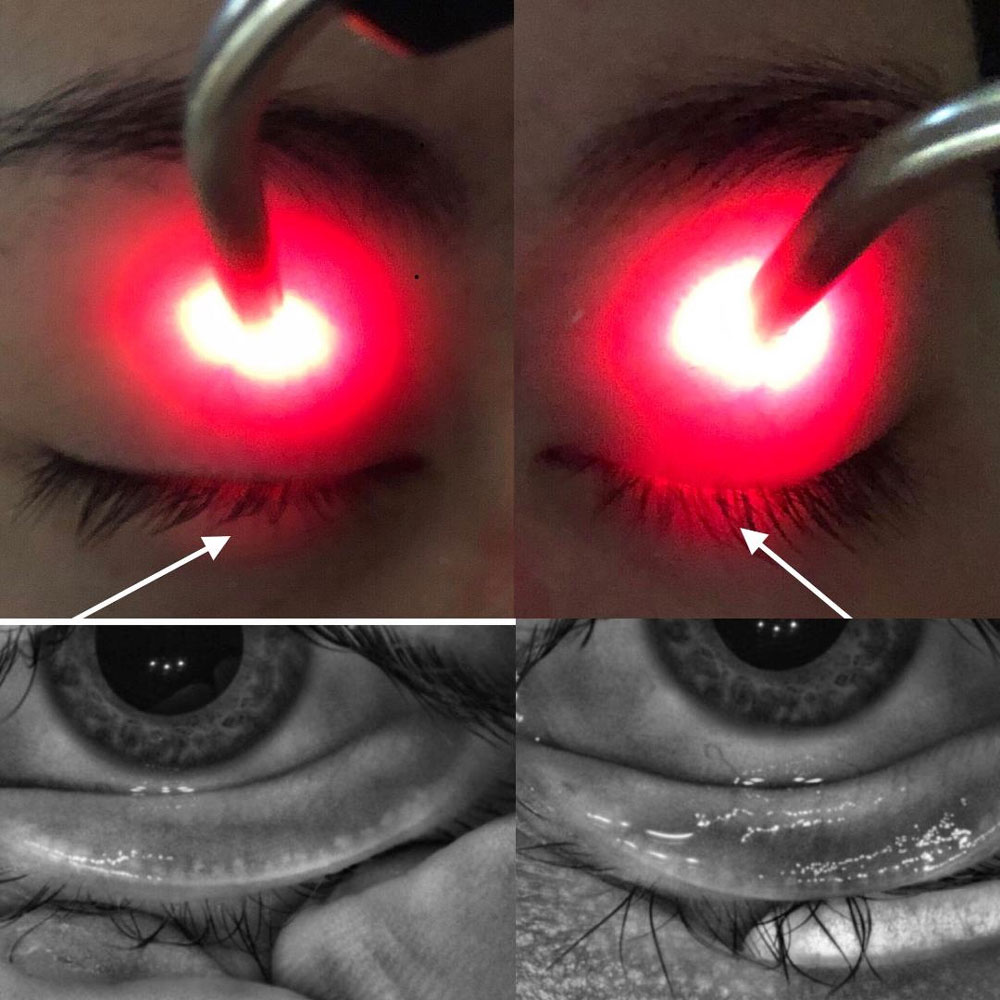 This 20-year-old college student with meibomian gland dropout and lid seal insufficiency had dry eye complaints. The student reported long computer hours, poor sleep, poor nutrition, excessive contact lens wear, and use of multiple over-the-counter and prescription acne treatment products. Source: Laura Periman, MD