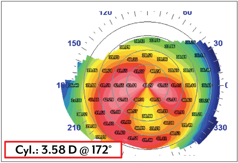 This is a 63-year-old female with pellucid pattern keratoconus; because the astigmatism is orthogonal centrally, she is an appropriate candidate for a toric IOL.  Source: William Trattler, MD