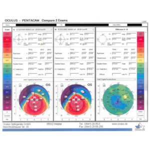 Read more about the article Keratoconus screening in the U.S.