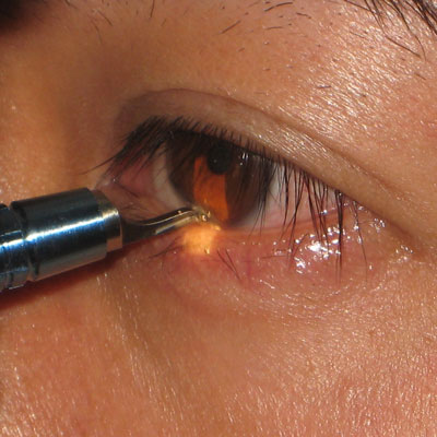 Read more about the article Using AK/LRIs to correct astigmatism