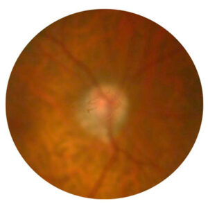 Read more about the article Performing cataract surgery with retina abnormalities