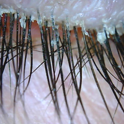 Read more about the article Demodex update: background, signs and symptoms, and treatment