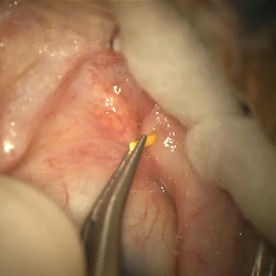 Read more about the article Options to reduce postop cataract surgery drops for glaucoma patients