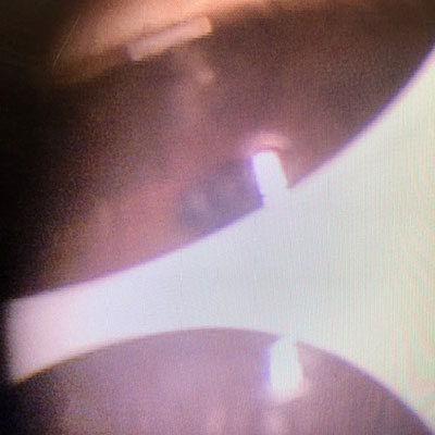 Read more about the article Durysta a year later: Physicians discuss early experience