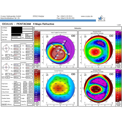 Read more about the article Technology, screening improvements decrease already low refractive surgery ectasia risk