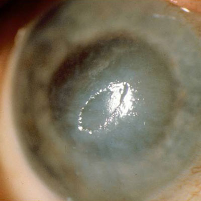 Read more about the article Herpes zoster update