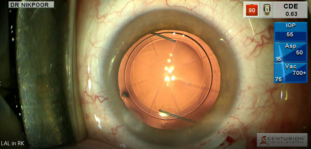 RLE in an RK patient with +5 D hyperopia; placed Light Adjustable Lens (RxSight) OU